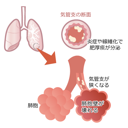 COPDの肺